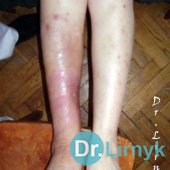 Erysipelas: after treatment. Treatment for 7 days.